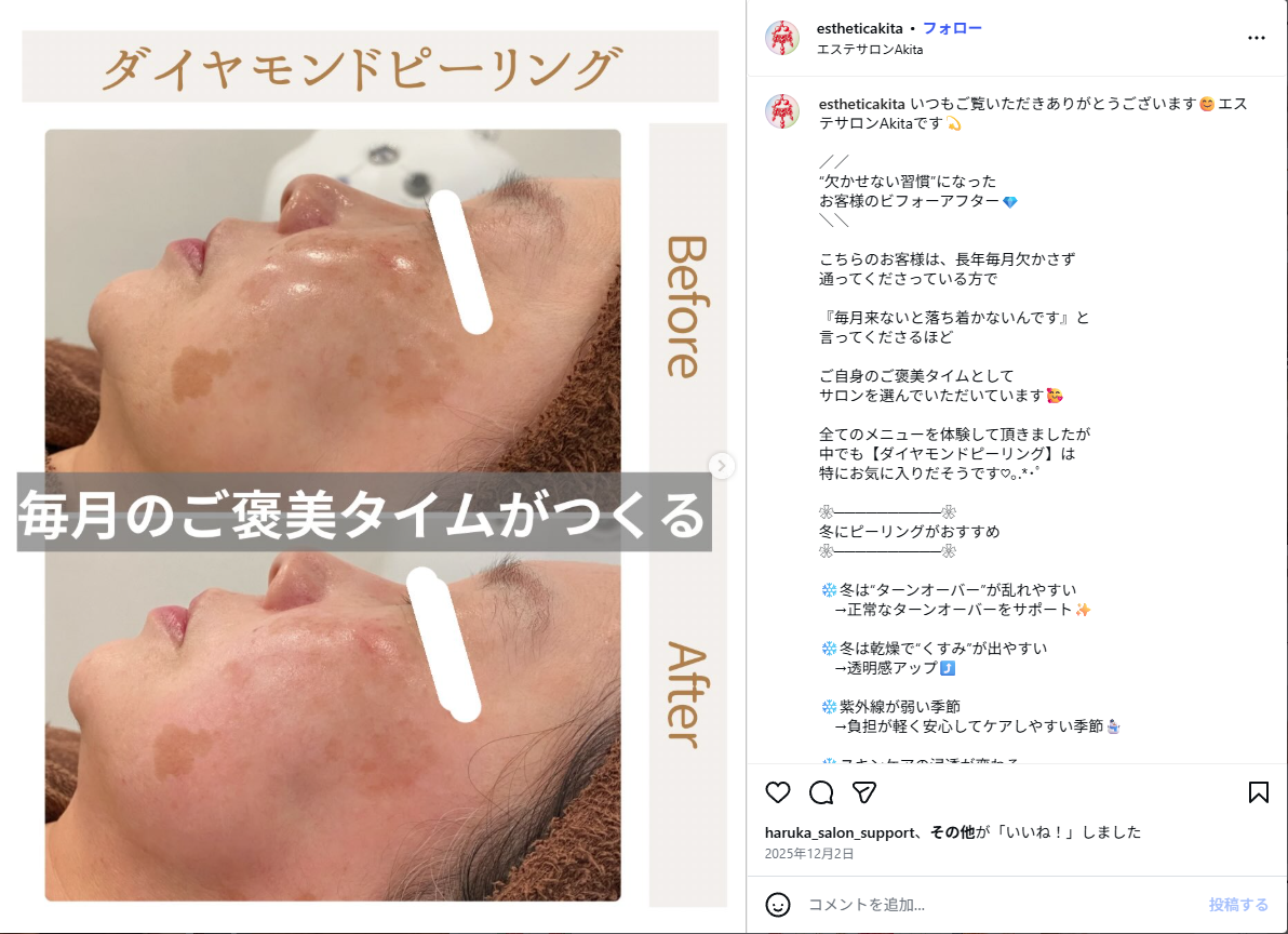 ダイヤモンドピーリング ビフォーアフター