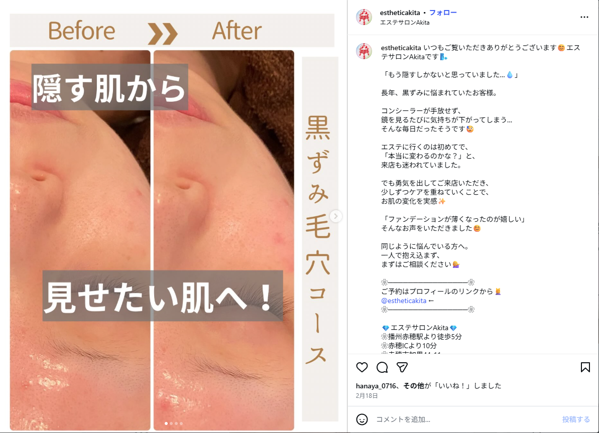 黒ずみ毛穴コース ビフォーアフター